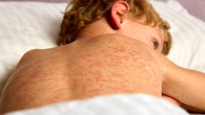 1010x567_alerta-sanitaria-537023-191657