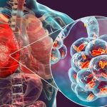 Tuberculosis: casos en Jujuy y síntomas que no deben ignorarse